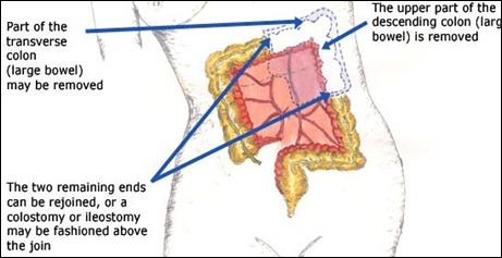 Hemi-colectomy | studynursing